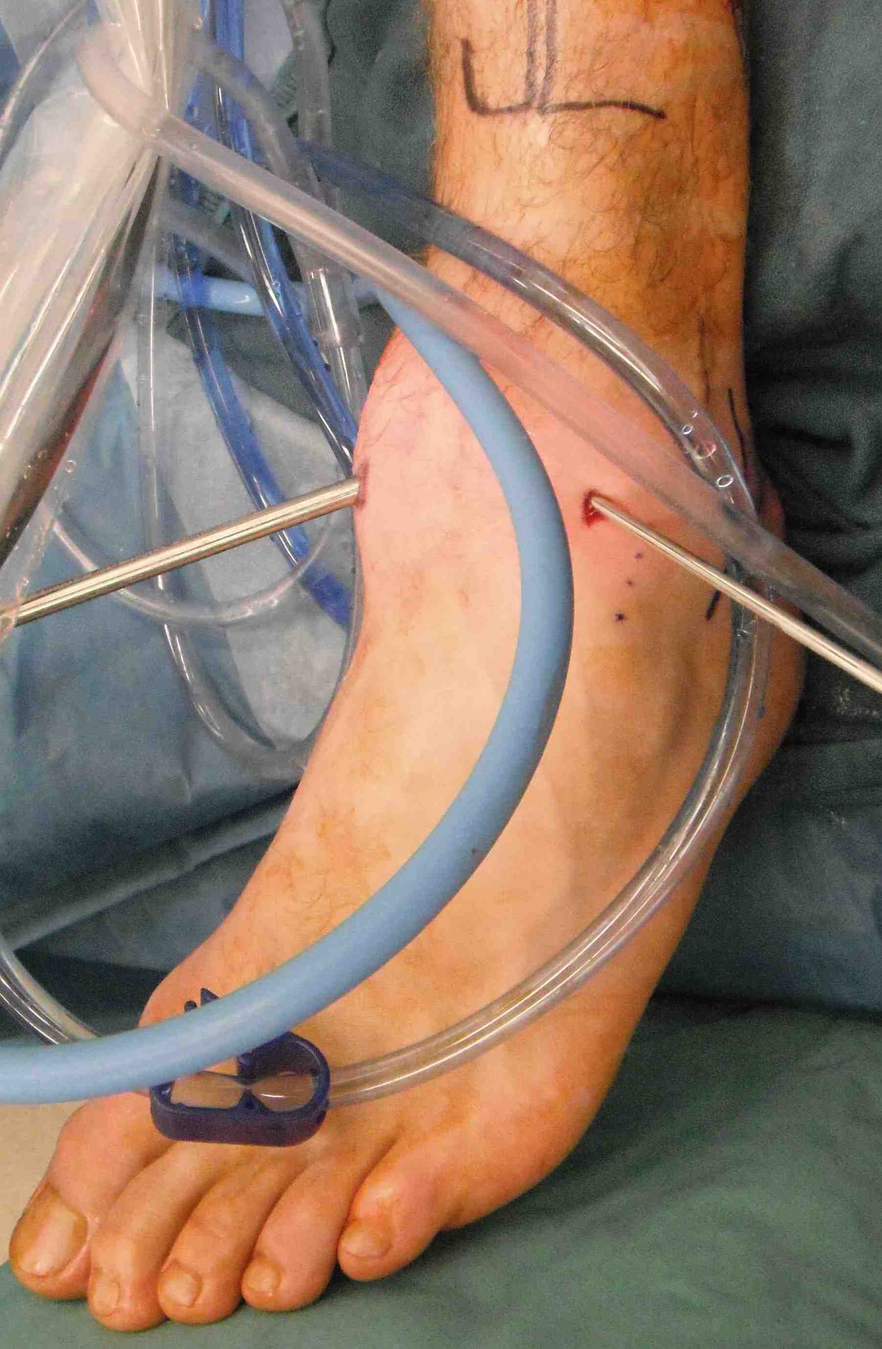 Ankle Arthroscopy